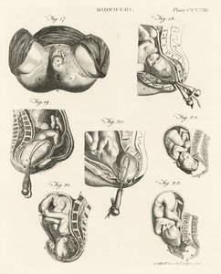 助産術、「百科事典ブリタニカ」のイラスト、エジンバラ、1798年に発行（銅版画） 作： Alexander Bell